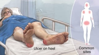 img-pressure-ulcer